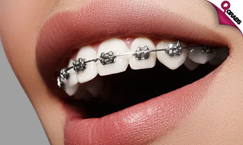 Metal Braces, Adjustment, Retainer & Consultation!